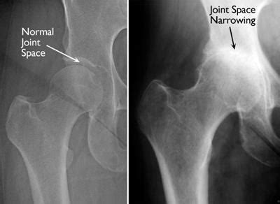 Joint Replacements & Osteoarthritis - Max Superspecialty Ortho Clinic