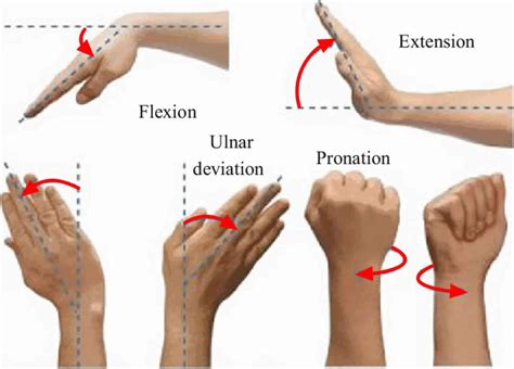 Ulnar deviation and ulnar drift definition and causes