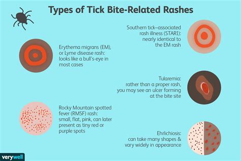 Signs, Symptoms, and Complications of Tick Bites