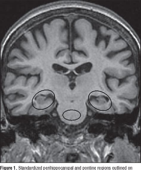 Figure 1 from Application of automated medial temporal lobe atrophy ...