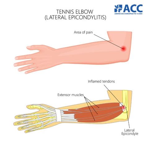 Elbow pain: Types and Treatments | ACC