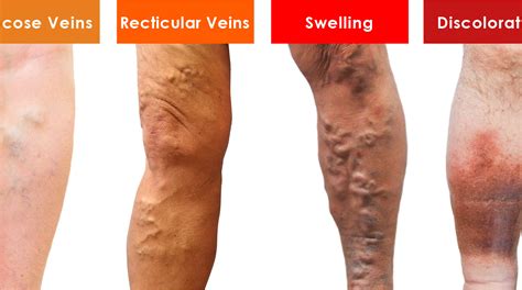 How to prevent an existing vein condition from worsening with time