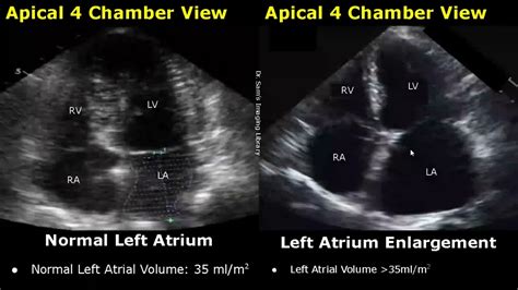 Normal Mitral Valve Echo