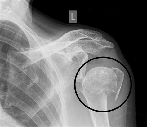 Proximal Humerus Fracture Presentation