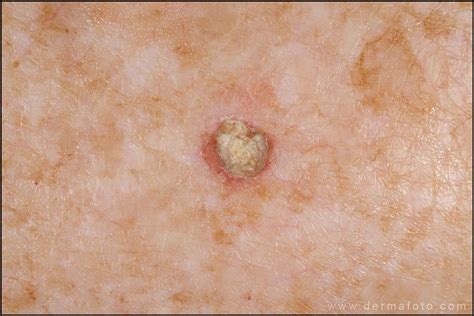 Actinic keratosis: potentially cancerous These spots feel rough and ...