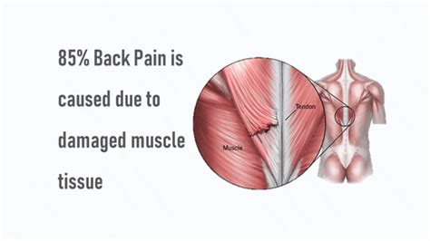 Muscle Strain Treatment | Back & Neck Muscle Strain Treatment & Causes