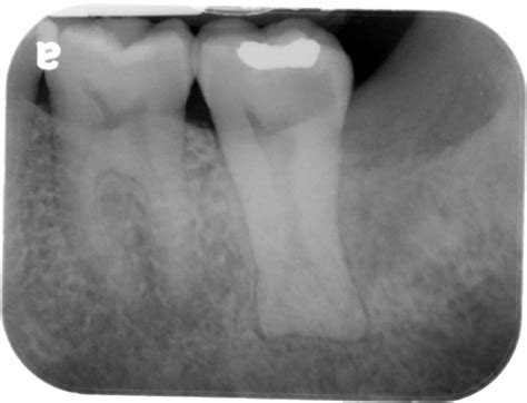 Taurodontism – Dr. G's Toothpix