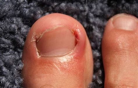 Ingrown Toenail: Remedies, When to See Your Doctor - SUCH TV