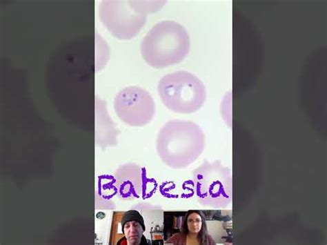 Babesia Peripheral Blood Smear Morphology Characteristics - YouTube