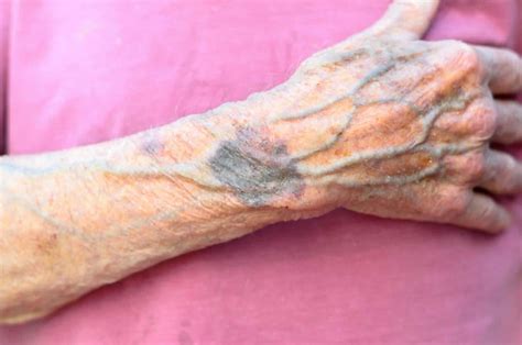 Collapsed vein causes, signs, symptoms, diagnosis & treatment