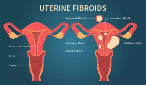 Tips For Managing Fibroid Symptoms Before Treatment