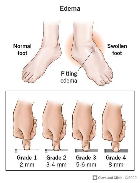 Pitting Edema: What Is It, Causes, Grading, Diagnosis,, 53% OFF