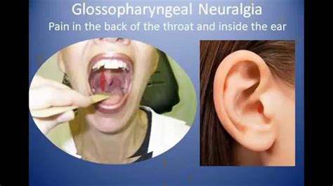 Decompression of 9th nerve for glossopharyngeal neuralgia - YouTube