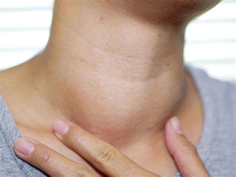 Goiter: What Is a Goiter?