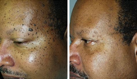 Mole Removal for Men in Richmond VA | Radiowave Treatment