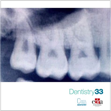 Maxillary Third Molar Extraction: Two Techniques Compared | Dentistry33