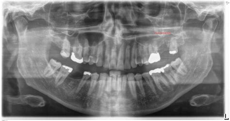 Maxillary first and second molars Surgically Removed