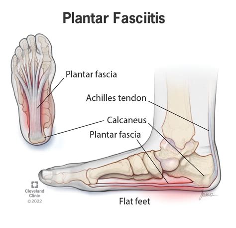 Plantar fasciitis - KealanCaicee