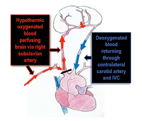 Deep Hypothermic Circulatory Arrest : WFSA - Resources