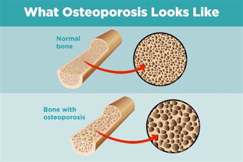 Arthrite inflammatoire et ostéoporose : Comprendre le lien ...