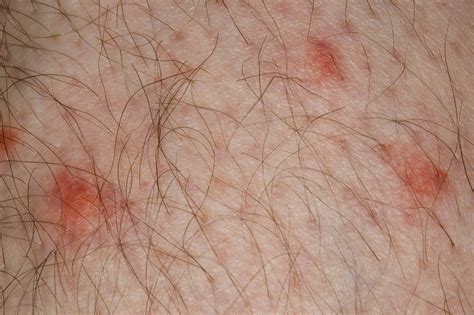 Insect bites and stings - Symptoms - NHS