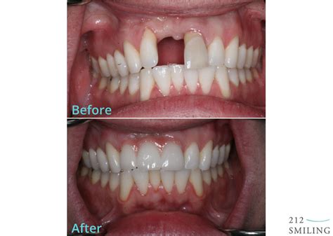 Ceramic Dental Bridge Before and After - 212 Smiling