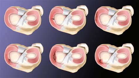 Types of Meniscus Tears – Howard J. Luks, MD