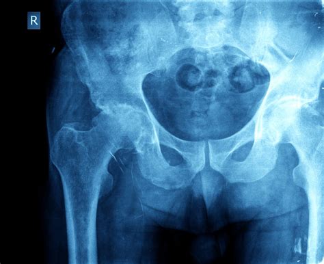 Hip osteoarthritis may not appear on X-ray