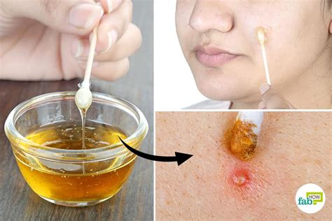 Honey for Acne: Top 10 Remedies and Masks | Fab How