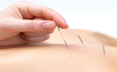 Acupuncture in the ED | NeuroLogica Blog