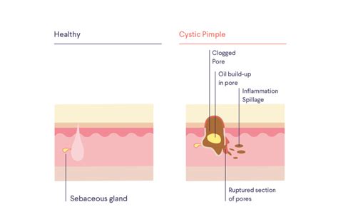 Abscess vs. cyst: what are they? | Curology