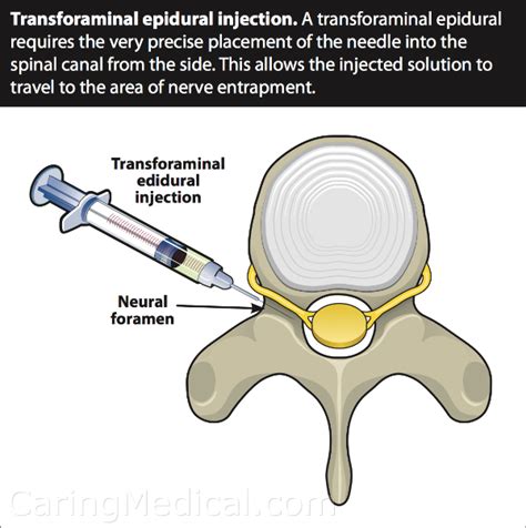 Cervical epidural steroid injections in complicated neck pain cases