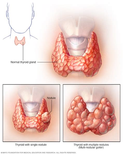 Goiter - Symptoms and causes - Mayo Clinic