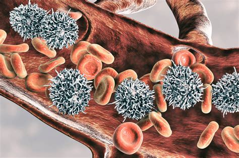 Hairy Cell Leukemia: Cladribine With Concurrent Rituximab May Improve ...