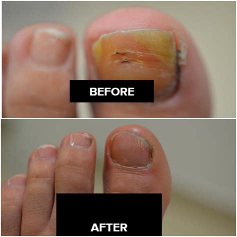 Best Fungal Nail Treatment Laser at Christine Wright blog