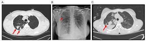 Microorganisms | Free Full-Text | Diagnosis and Management of Pulmonary ...