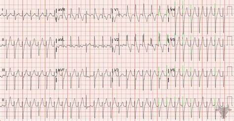 Ventricular Tachycardia Ecg