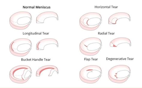 Meniscal tears: the basics - BSM Foundation