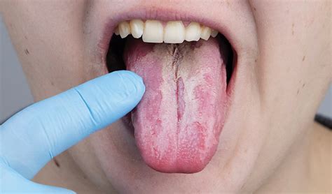 RACGP - Common benign and malignant oral mucosal disease