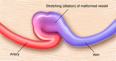 Arteriovenous Fistula - For Dialysis, Dural, Symptoms