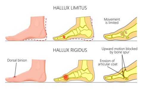 Hallux Rigidus Causes & Management Singapore - Straits Podiatry