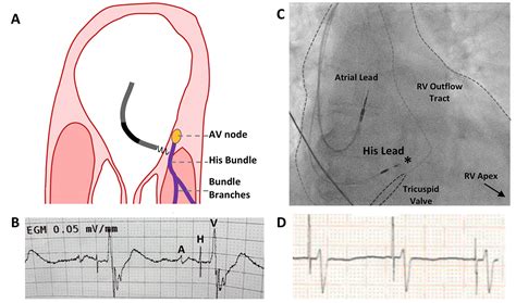 Pacing supplement: His-bundle pacing - UK experience and HOPE for the ...