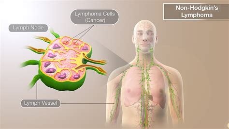 How To Diagnose Non Hodgkins Lymphoma - Theatrecouple12