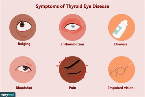 Thyroid Eye Disease: What It Is, Symptoms, and Treatment