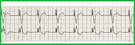 Float Nurse: EKG Rhythm Strip Quiz 182