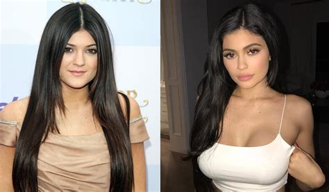 Kylie Jenner's Plastic Surgery Transformation | The Blemish