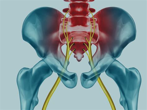 Sciatica: sciatic nerve compression-causes, symptoms and treatment ...