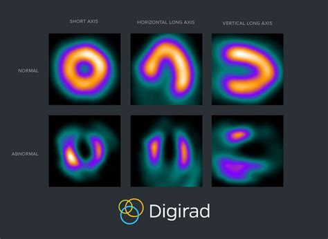 What is SPECT imaging and how does it work? | Nuclear Imaging