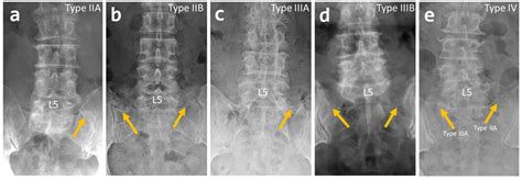 Surgeries | Free Full-Text | Prevalence of Lumbosacral Transition ...