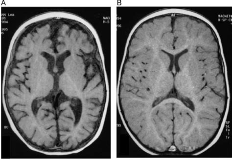 Brain atrophy in a child with vitamin B12 deficiency and its reversal ...